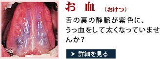 あなたの舌は陰虚かも